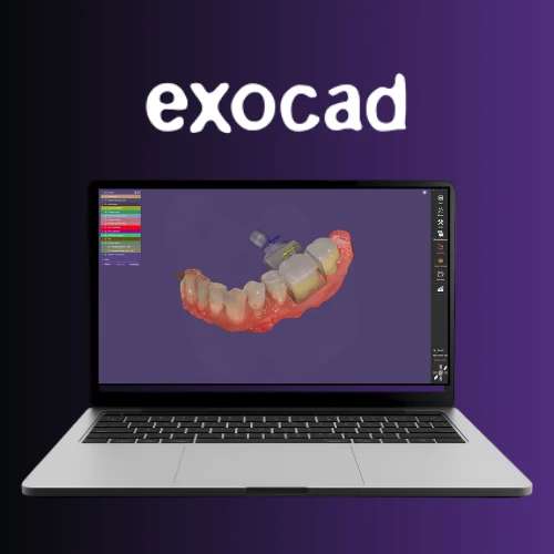 Laptop displaying an exocad dental restoration design