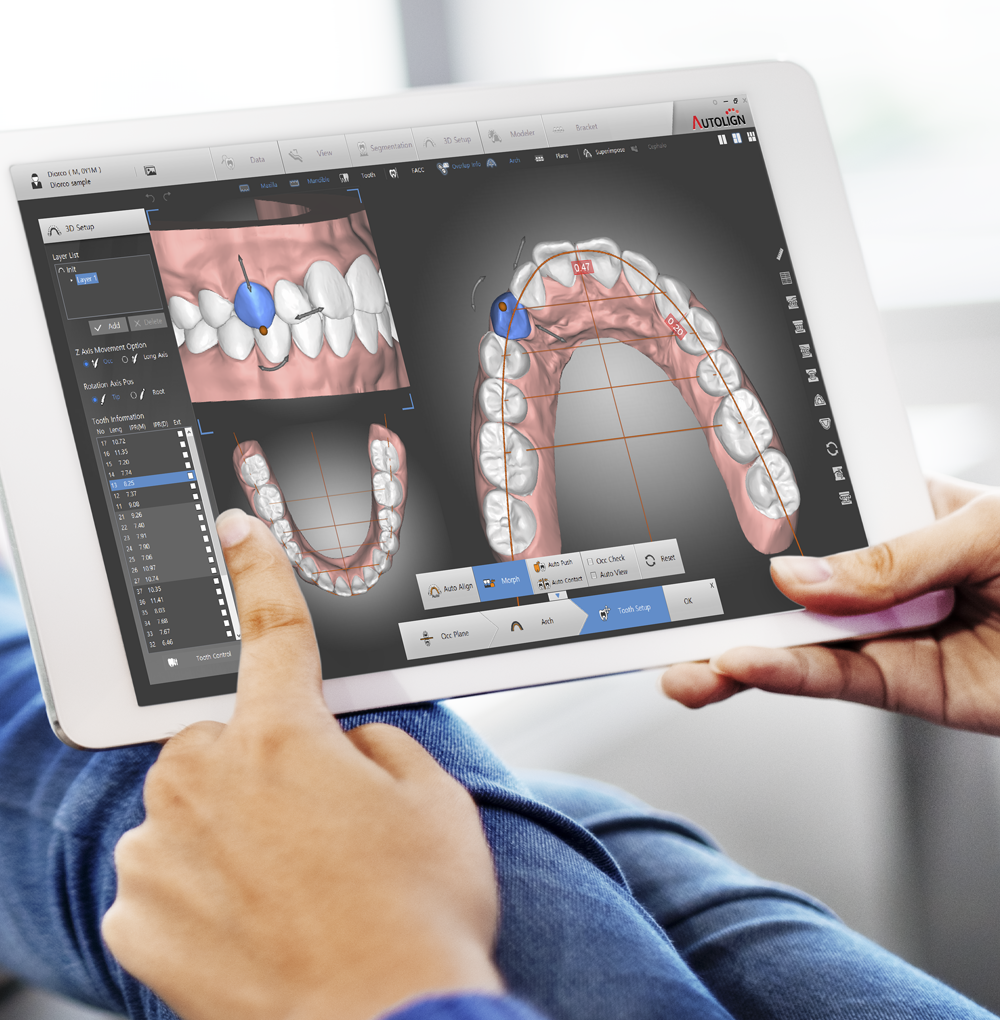 Autolign orthodontic setup software on a tablet