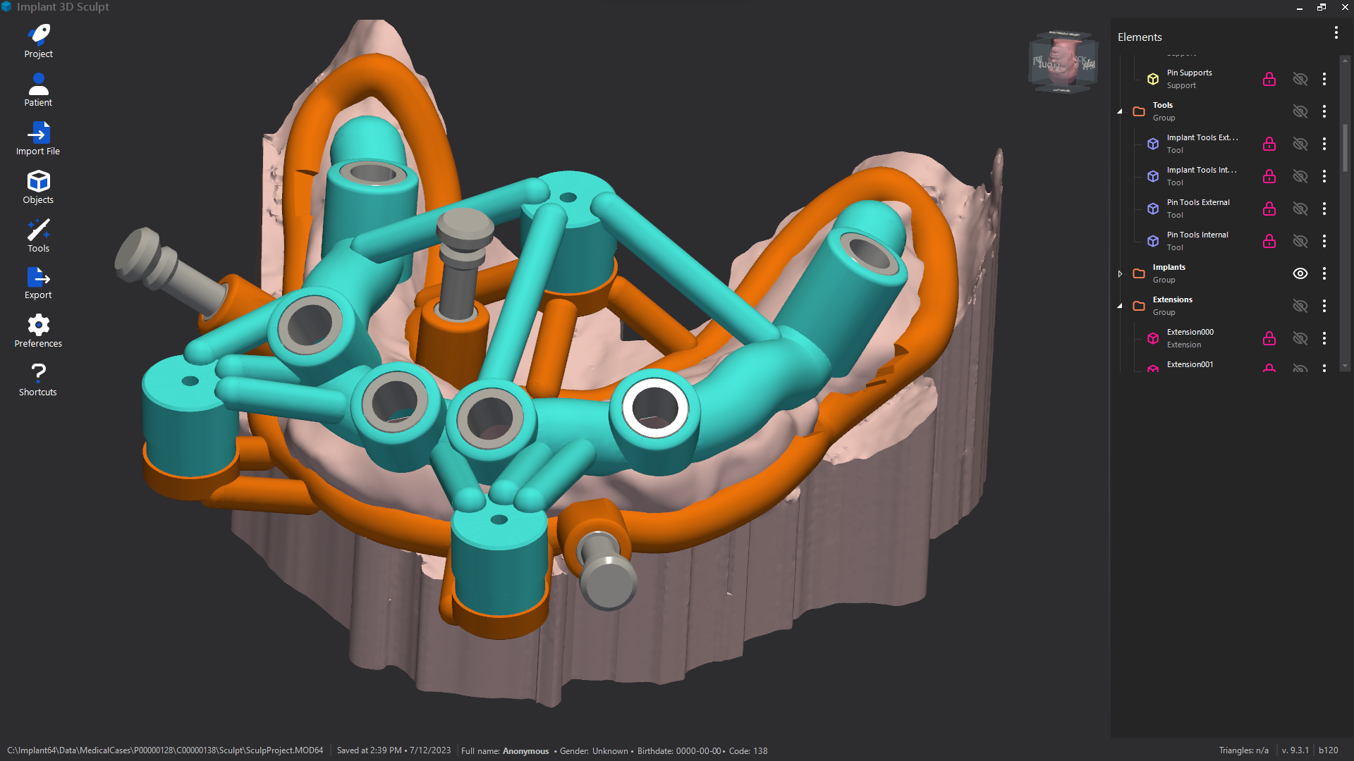 Implant 3D Sculpt stackable guide illustration