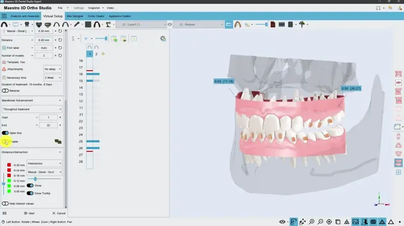 Maestro 3D orthodontic setup screen