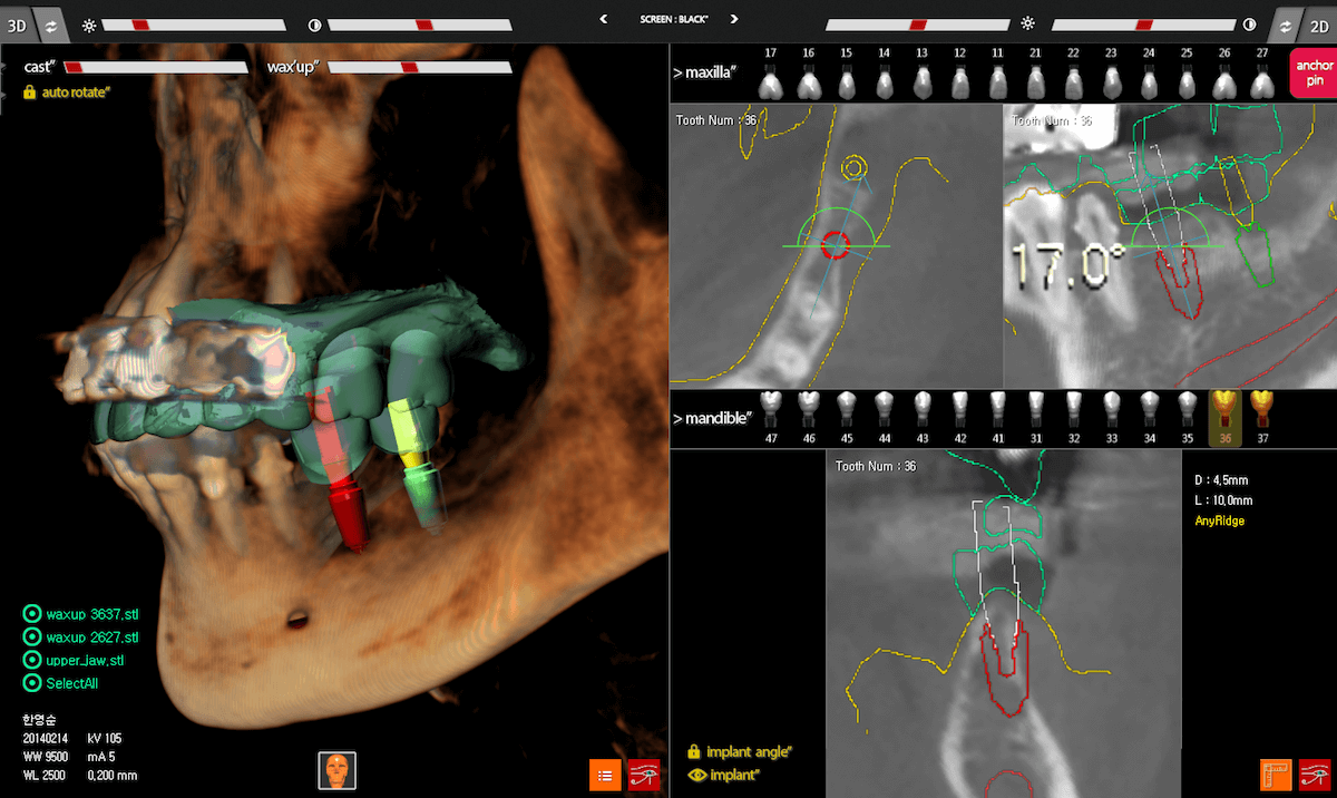 R2GATE implant planning screen